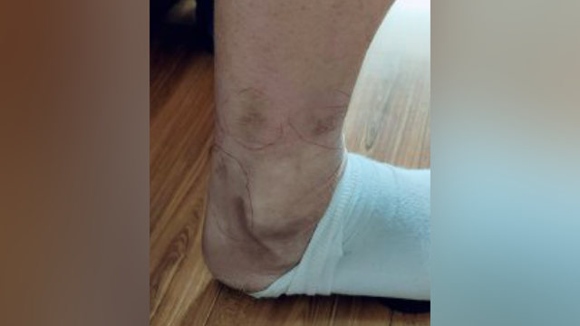 趙剛腿上留下的電擊疤痕（知情人提供）
